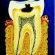 Средний кариес зубов и его лечение