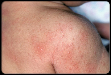 Аллергия на антибиотики у ребенка