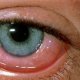 Как выбрать глазные капли от аллергии