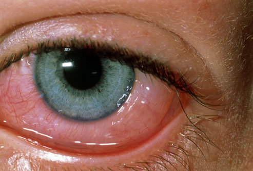 Как выбрать глазные капли от аллергии