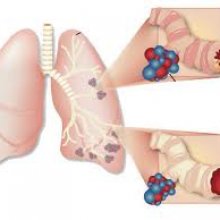 Какие бывают виды и причины астмы