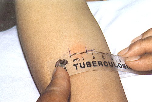 Очаговый туберкулез легких. Лечение