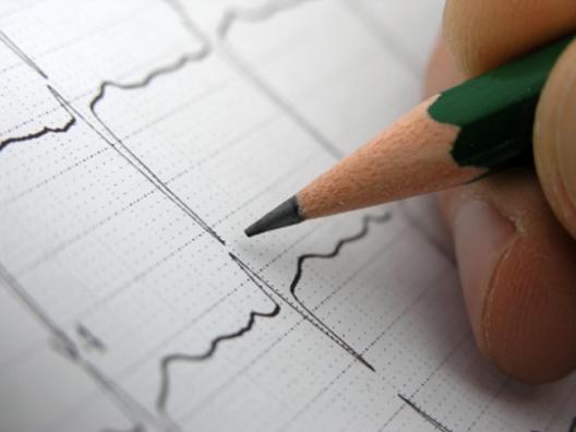 Как определить симптомы аритмии сердца