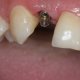 Импланты в стоматологии