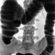 Рентген кишечника как способ диагностики его заболеваний