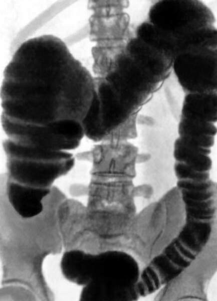 Рентген кишечника как способ диагностики его заболеваний