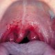 Сыпь в горле – признак инфекции