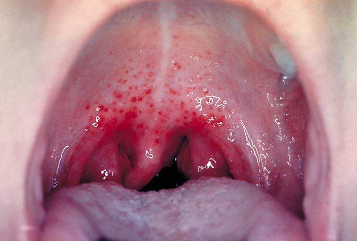 Сыпь в горле – признак инфекции