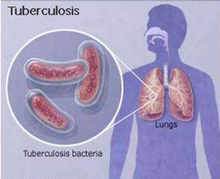 Кто открыл бактерии туберкулеза