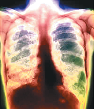 Определение туберкулеза: 6 способов