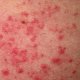 Кожный дерматит — самое распространенное кожное заболевание