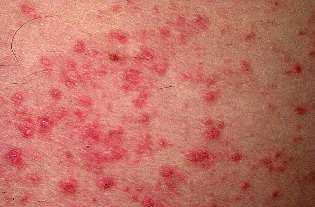 Кожный дерматит - самое распространенное кожное заболевание