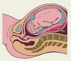 Отслойка плаценты при беременности 
