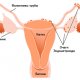 Как происходит удаление эндометриоза