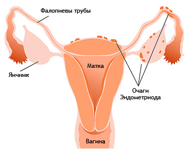 Как происходит удаление эндометриоза