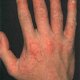 Лечение атопического дерматита у взрослых