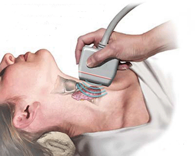 Узловой зоб щитовидной железы: причины, симптомы и лечение