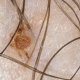 Педикулез лобковый — паразитирование площиц