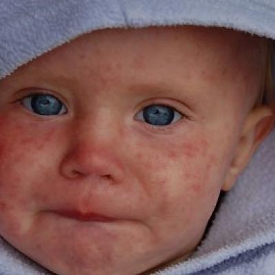 Описание заболевания и вакцина против краснухи