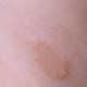 Что такое микроспория кожи и методы её лечения