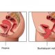 Симптомы и способы лечения послеродового опущения матки