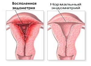 Воспаление матки или эндометрит - опасное заболевание