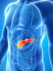 Панкреатит - это воспалительный процесс в поджелудочной железе