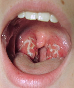Герпесная ангина у детей является разновидностью обычной ангины, которая вызывается вирусом Коксаки