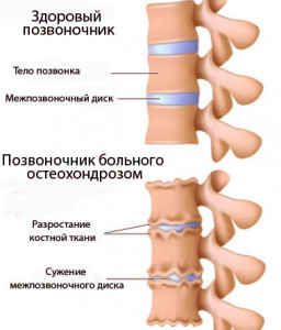 Остеохондроз пояснично-крестцового отдела позвоночника сопровождается болевыми ощущениями в спине и пояснице