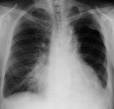 Рентгенологическое исследование имеет огромное значение в изучении состояния органов дыхания