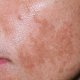 Удаление пигментных пятен: как быстро и эффективно улучшить состояние кожи?