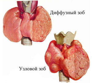 Результат ультразвуковой диагностики: диффузное увеличение щитовидной железы