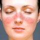 Заболевание кожи лица и кистей рук – экзема хроническая