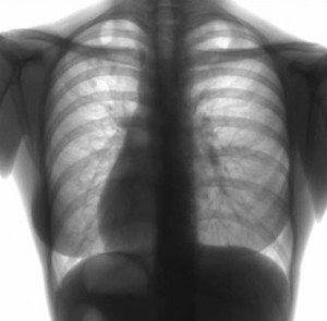 Наиболее информативным методом диагностики очагового туберкулеза считается рентгенограмма