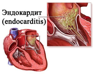 Эндокардит – это воспаление оболочки сердца, в большинстве случаев затрагиваются клапаны