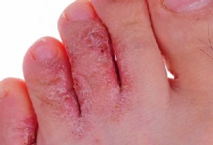 Микозы кожи стоп сопровождаются появлением пузырьков с жидкостью, зудом, болевыми ощущениями
