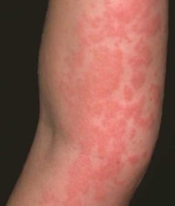 Больше всего аллергия проявляется появлением крапивницы или зуда