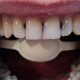 Кариес между зубами. Причины и лечение