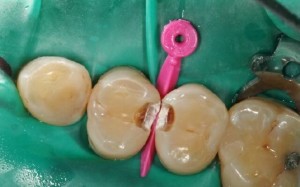 Довольно часто можно столкнуться с тем, что стоматолог обнаружил кариес между зубов