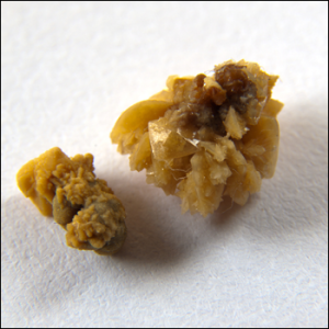 Оксалатные камни появляются из-за высокого содержания щавельной кислоты в моче