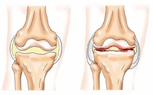 Первой целью лечения болезни есть устранение боли в зоне колена
