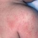 Средства от аллергии на коже