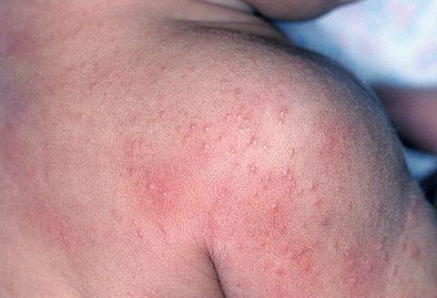 Средства от аллергии на коже