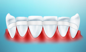 В целом процедуру шинирования современные стоматологи выполняют очень качественно и практически безболезненно