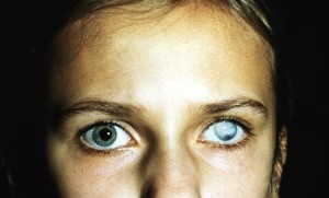 Среди серьезных нарушений зрения бельмо встречается весьма часто