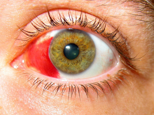 Лечение кровоизлияния в сетчатку глаза