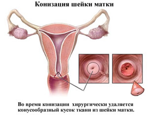 Менструации после операции будут намного обильнее и продолжительнее, нежели раньше