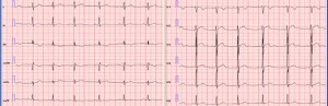 Синдром ранней реполяризации сердца -  это появление в ЭКГ (электрокардиографии) нехарактерных для нее изменений
