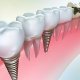 Имплантант зуба: сущность и стоимость