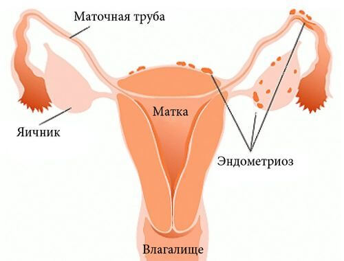 Как остановить маточное кровотечение при эндометриозе